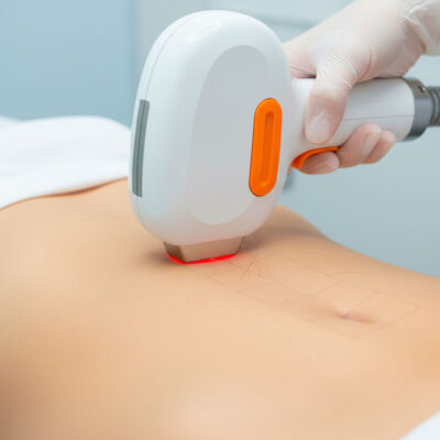 Depilación Línea alba