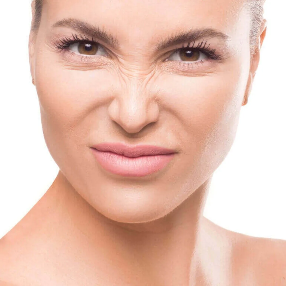 Toxina Botulínica Bunny Lines