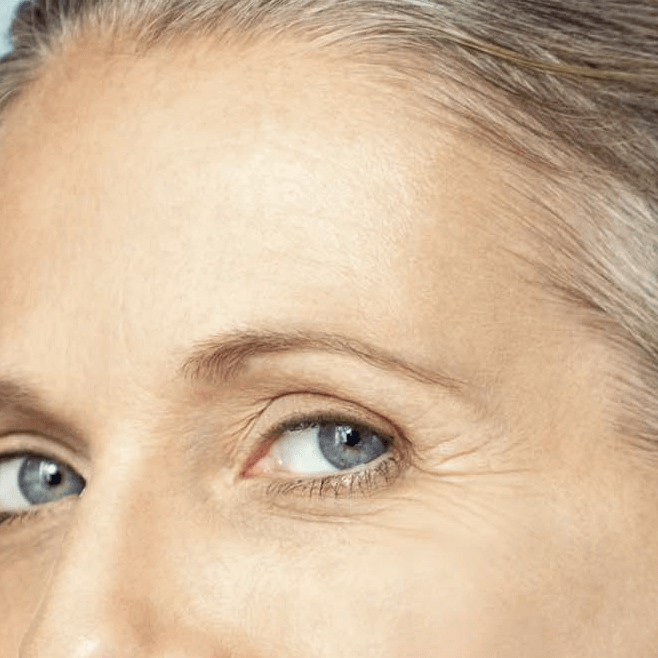 REDERMALIZACIÓN DE OJERAS CON XELA REDERM